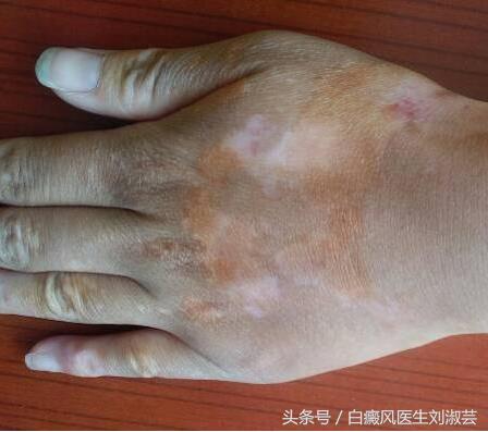 当你得了白癜风,白癜风抹药后起了水泡严重吗