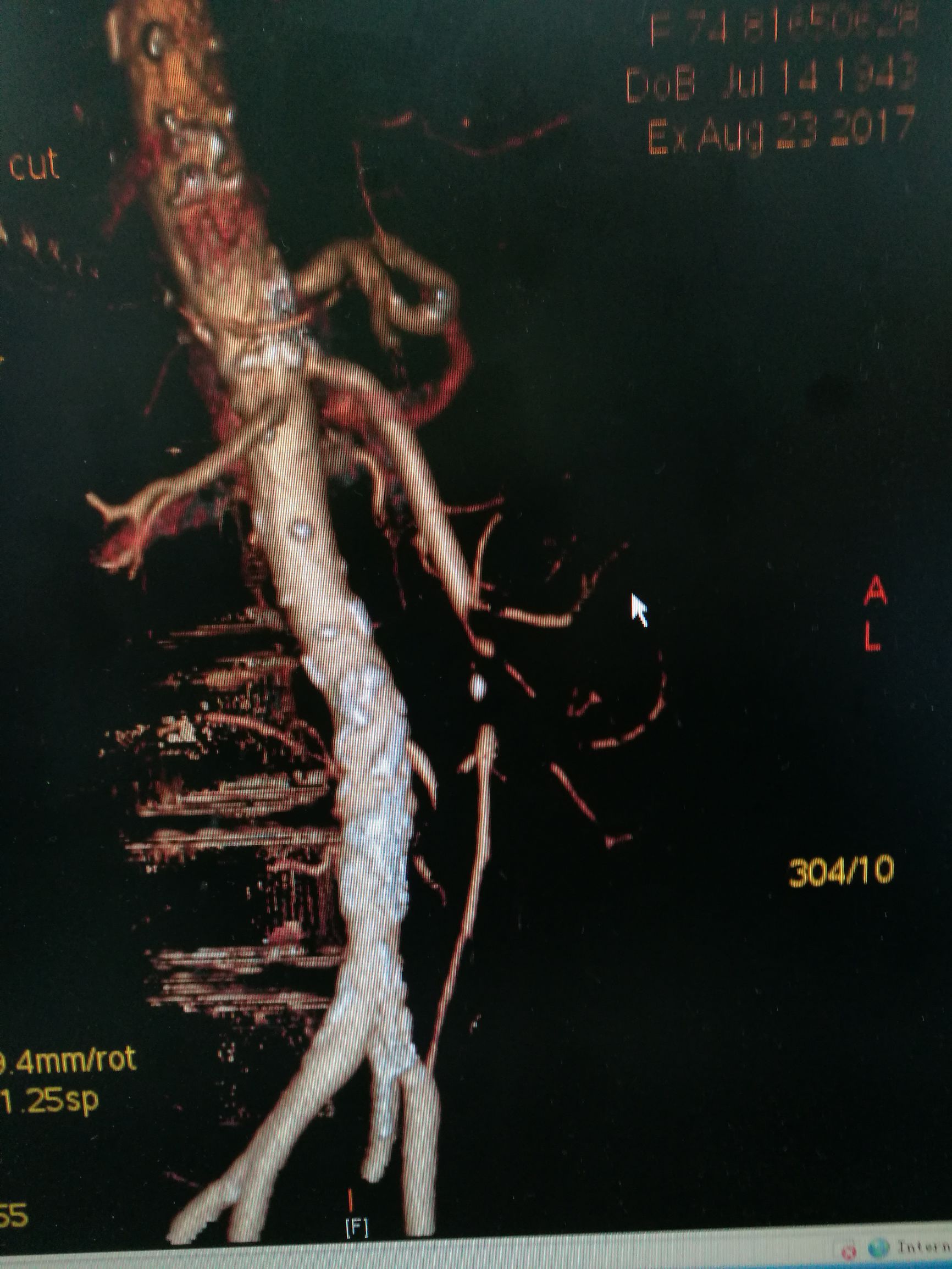 要命的肠缺血被轻松化解