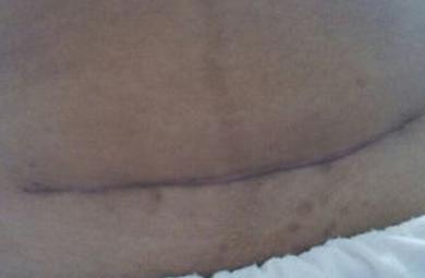 剖腹产拆线后48天伤口裂开,剖腹产后三个月伤口会裂开吗