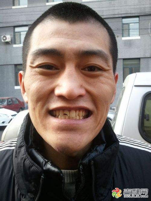 牙齿畸形究竟要不要矫正,儿童牙齿错颌畸形什么时候矫正