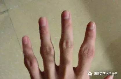 类风湿关节炎的病人能不能吃“发物”