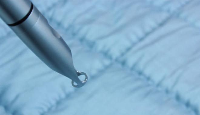 亲身经历碘油造影，有点可怕有点痛