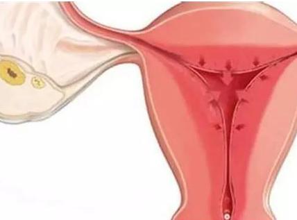 更年期子宫内膜增厚的症状和治疗,子宫内膜增厚怎么才能彻底治疗好