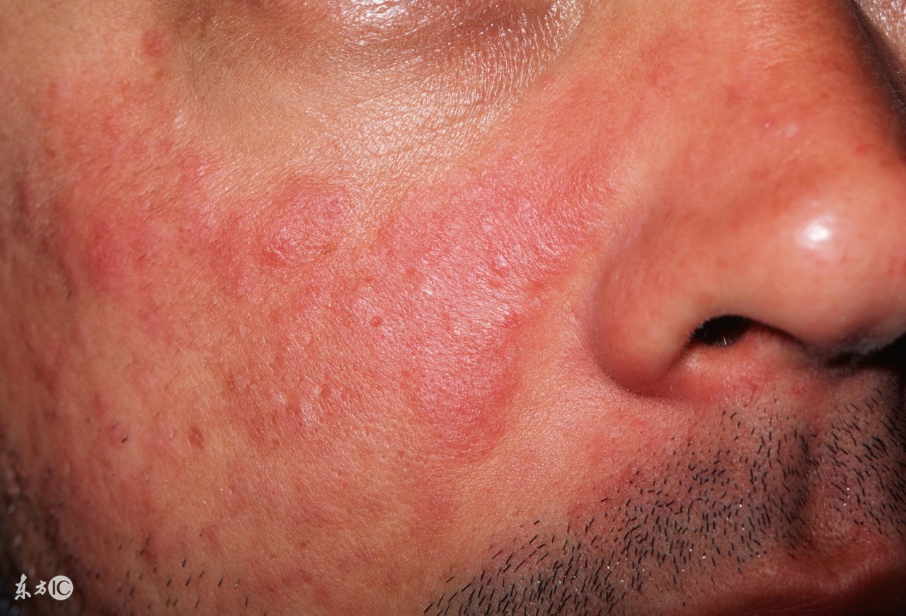 红斑狼疮临床表现记忆口诀,红斑狼疮记忆能恢复吗