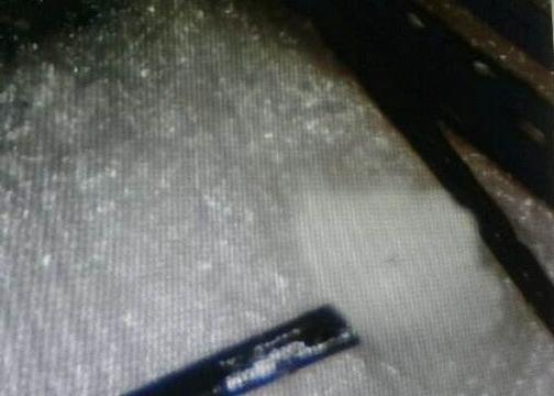 头发里的白色颗粒是脂溢性脱发吗,头痒抠出的黄泥是什么