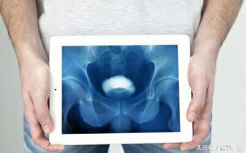 男性膀胱癌症状的早期表现,男性膀胱癌有七种症状