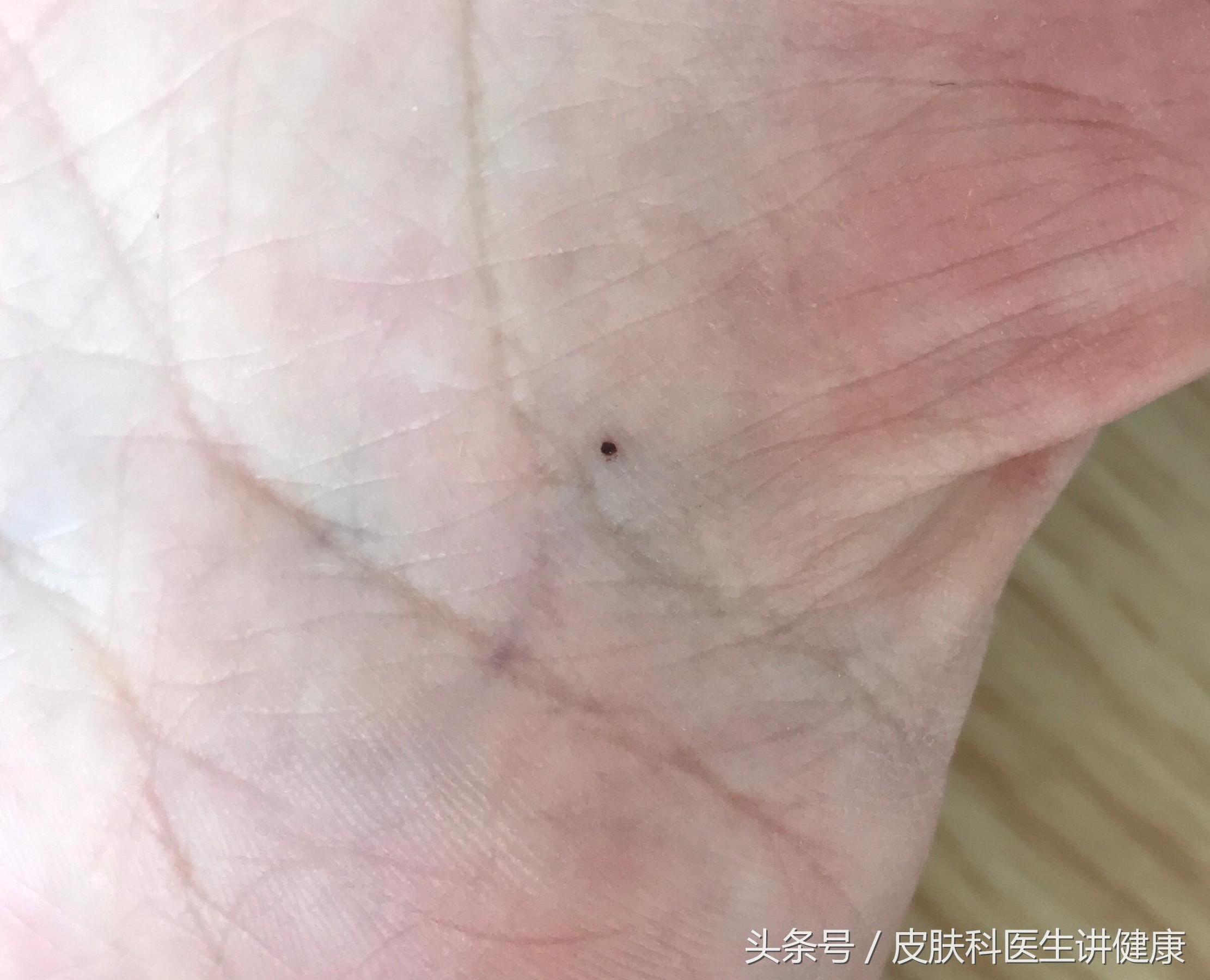 长在左眼旁边的色素痣会恶变吗,手心突然出现色素痣癌变几率