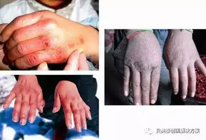 冻伤的病理生理变化阶段,简述冻伤的分度及治疗方法