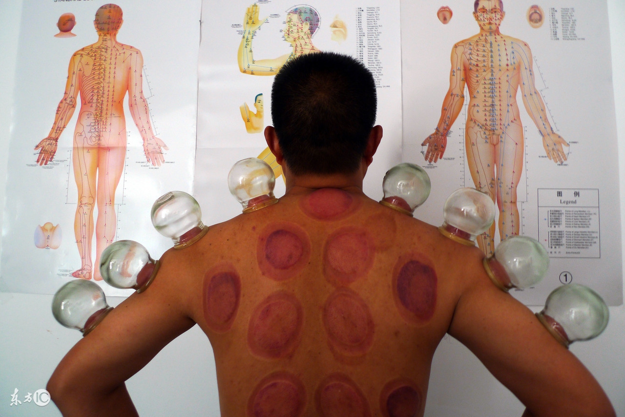 拔罐能祛除人体湿气吗,拔罐可以祛除体内湿气吗