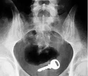 6岁小孩流脓,小孩身体底下流脓怎么办