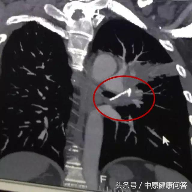 男子咳嗽两年未好转检查结果吓人,35岁男人长期咳嗽