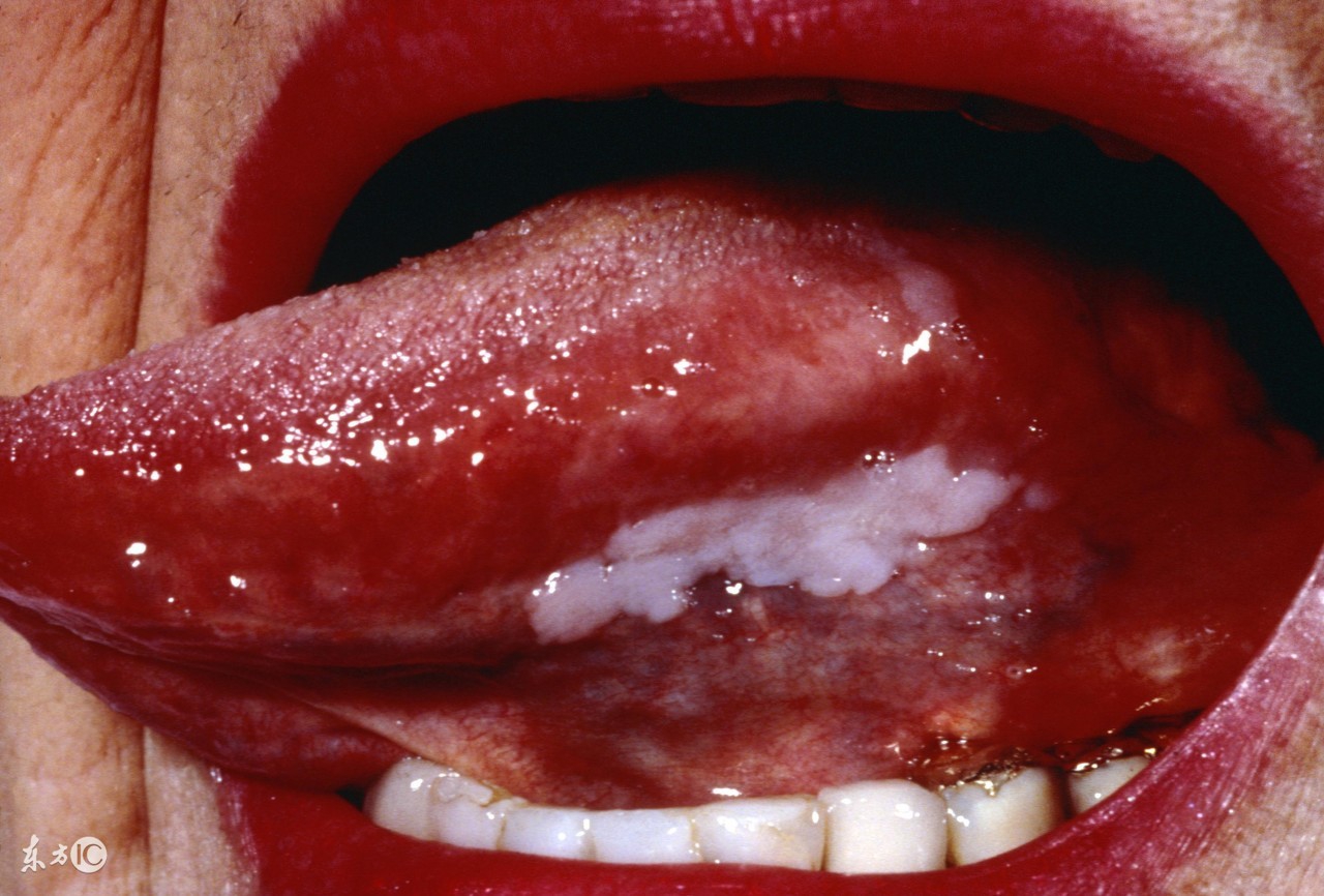 外阴白斑会发生癌变吗,外阴白斑会发生癌症吗