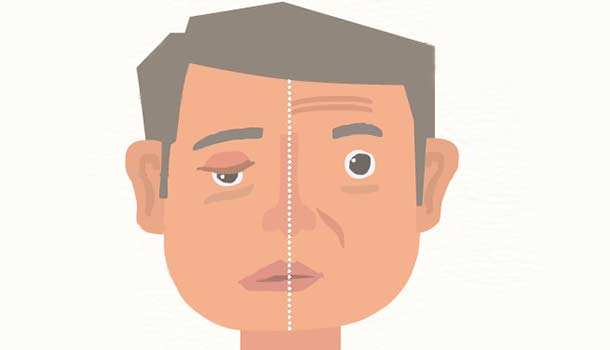 大小眼属于五官畸形吗,引起眼歪斜的所有原因