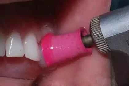 牙齿缝隙有黑的怎样去掉,幼儿的牙齿有黑污垢怎么去掉