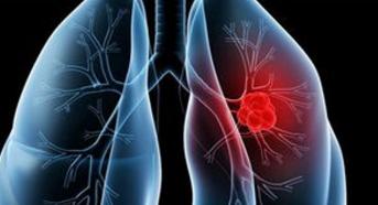 防治肺癌莫掉入这些误区