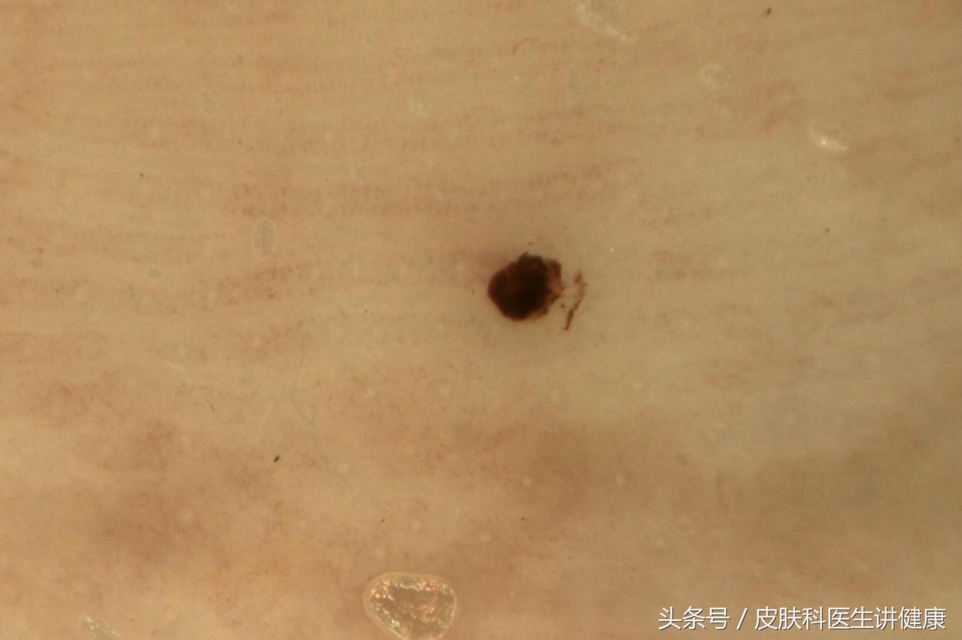 超过30岁脸上的斑点越来越多,突然长出来的色素痣会自行消退吗