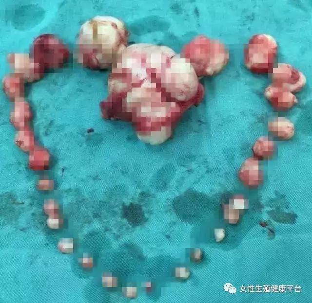 29岁女子子宫里长110颗肌瘤，长了这么多都没发现，竟是……