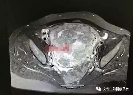 29岁女子子宫里长110颗肌瘤，长了这么多都没发现，竟是……