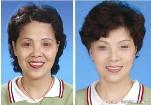 超声刀可以除皱吗,超声刀后脸部肿胀怎么办