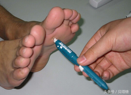 糖尿病的14个隐藏症状，出现7种以上的赶紧测一测血糖