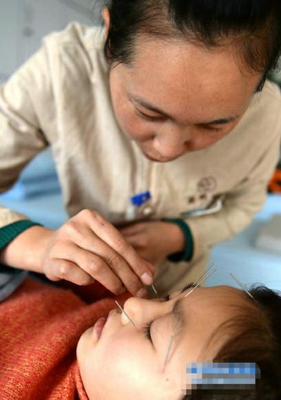 针灸真的没有副作用吗,针灸不对症有什么危害