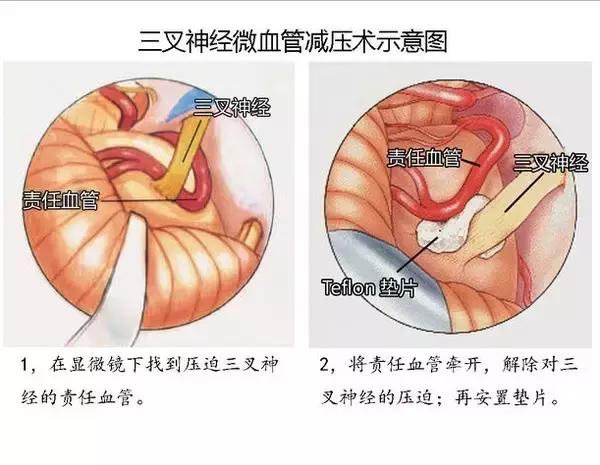 健康——武汉市中心医院王潞教你解决“天下第一痛”