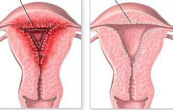 宫颈炎性疾病可怕吗,慢性宫颈炎可怕吗