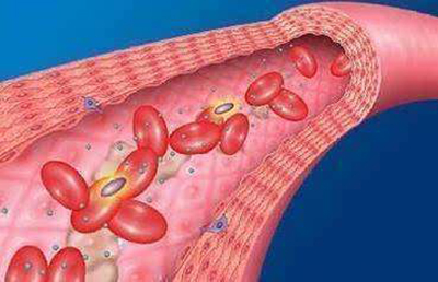 半导体激光真的可以降血压降三高,血液净化能治疗高血压吗
