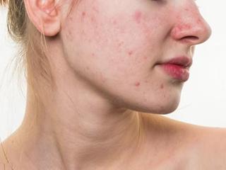 用手挤脸上的痘痘,挤脸上的痘痘会爆炸