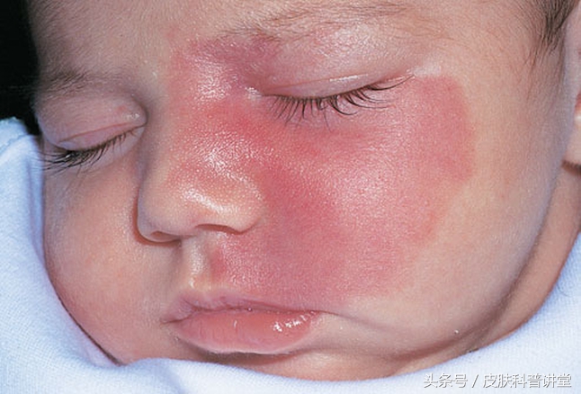 冷冻可以治疗鲜红斑痣胎记吗,治疗鲜红斑痣胎记的方法有哪些