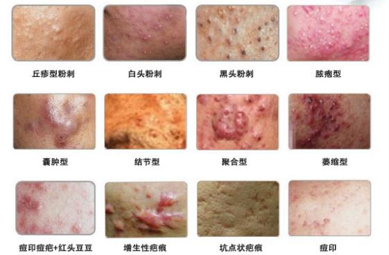 红蓝光祛除痘痘,红蓝光治痘痘方法