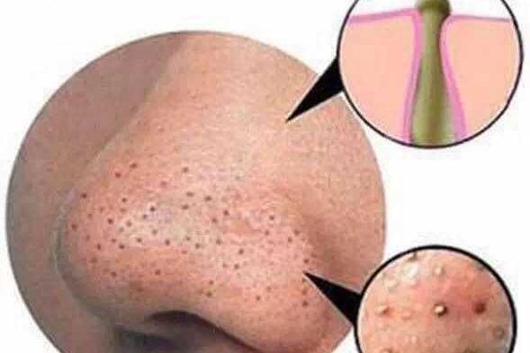 怎么收缩毛孔去除黑头小妙招,去黑头怎么收缩毛孔小妙招