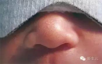 新生儿宝宝红疹子怎么引起的,新生儿皮肤起红疹子怎么办