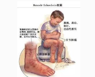 如何诊断过敏性紫癜损害肾脏,北京儿童医院看过敏性紫癜名医