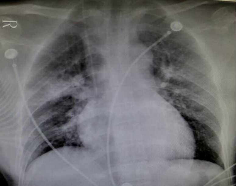 洁厕灵的危害有多可怕,洁厕灵会引起哪些反应