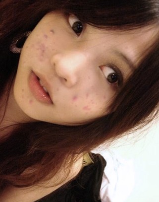 学生祛痘小技巧一晚就消除,祛痘超有效小妙招