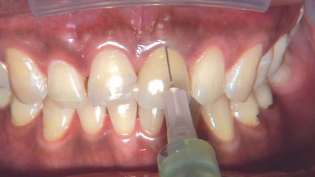 牙齿痛的小知识,牙很疼又不能拔牙怎么缓解疼痛