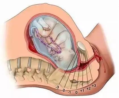 侧切和剖腹产哪个难受,侧切和剖腹产哪个严重