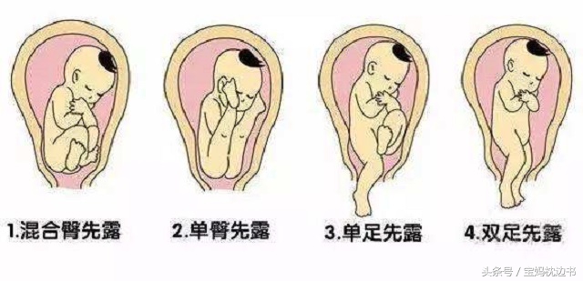 分娩期孩子头朝下,分娩头先出来还是脚先出来