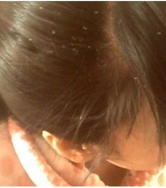 头皮屑最好最快解决方法,头皮屑满天飞了怎么办