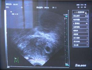 胎囊没有胎心胎芽是什么样的,有胎囊没有胎心胎芽什么原因