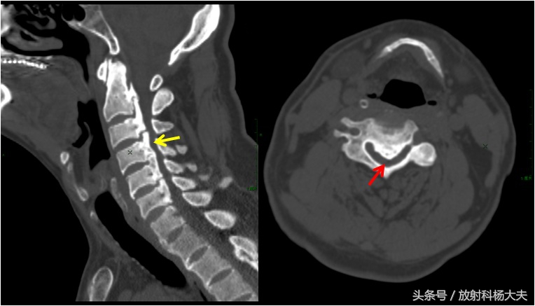 有些人颈椎病为什么那么严重,最可怕的颈椎病