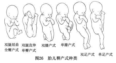 b超臀位胎儿是啥样的,b超臀位是什么意思需要纠正吗