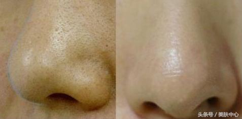 脸上毛孔堵塞怎么办小窍门,脸上毛孔经常被堵塞怎么办