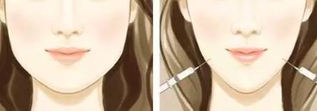 瘦脸针防止凹陷,瘦脸针注意避坑