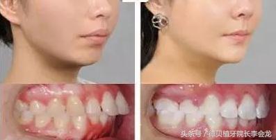 牙齿不齐矫正牙齿的最佳年龄,牙齿排列不齐有必要矫正吗