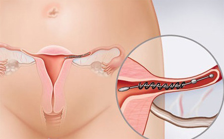 有过宫外孕史，这样备孕才够科学