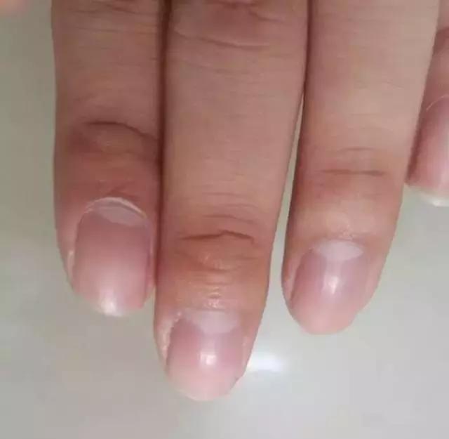 指甲竖纹变少了,指甲竖纹发白没血色