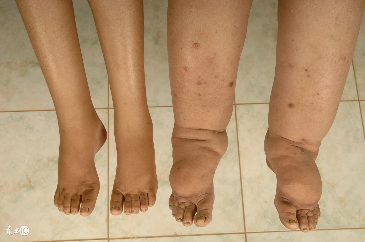 怀孕了肿了怎么办,什么体质怀孕后容易肿