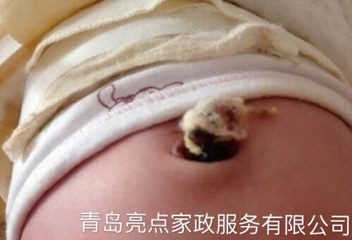 宝宝脐炎的症状图,脐茸和脐炎需要住医院吗